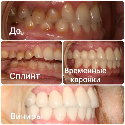Виниры до/после - стоматология Орбиталь