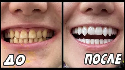 Виниры. Зубы до и после установки виниров. Моя история - YouTube