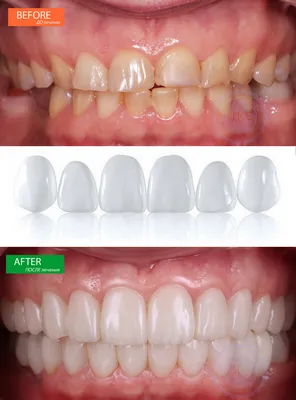 Патологическая стираемость. Как восстановить зубы при помощи керамических  виниров