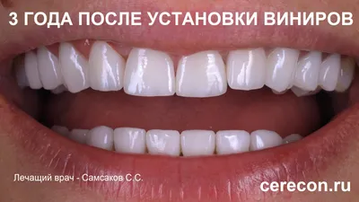 Поставить виниры на зубы, изменив улыбку в клинике Церекон Москва
