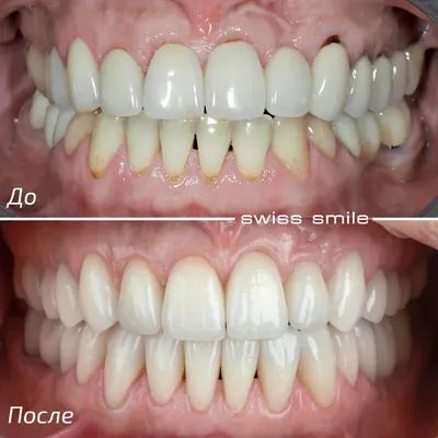 Виниры для зубов в Москве, клиника Swiss-smile результаты до и после