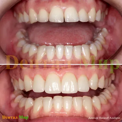 Установка 6 виниров на верхнюю фронтальную группу зубов, с коррекцией десны