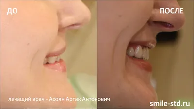Как виниры исправили асимметрию улыбки у девушки – клиника Smile STD, Москва