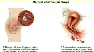 Медикаментозное прерывание беременности - Arimed