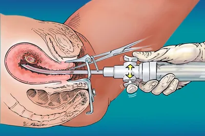 Выскабливание полости матки в Ростове-на-Дону | Цена на ВПМ от 5 000 руб. |  Центр \"Best_Clinic\"