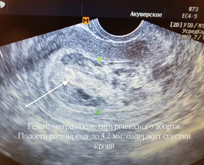 Хирургический аборт в СПб, доступная цена на хирургическое прерывание  беременности - клиника гинекологии «ЛИЦ»