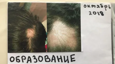 Что такое алопеция? Почему выпадают волосы и что с этим делать? - 21 января  2021 - e1.ru