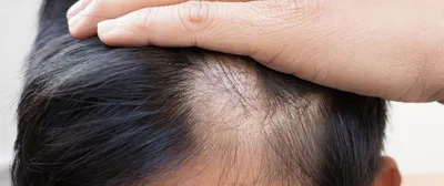 Очаговая алопеция – лечение очагового выпадения волос в Москве, цены –  An-Tech Labs