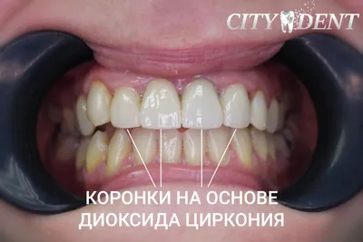 Лечение кариеса - Стоматология CITY DENT