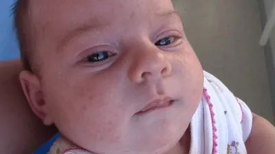 Неонатальный пустулез (Цветение новорожденных, гормональная сыпь или акне  новорожденных) - YouTube