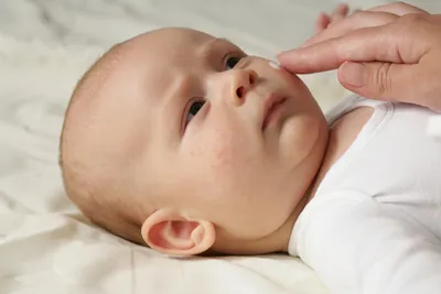 У месячного ребёнка сыпь на лице | Журнал WDAY