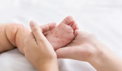 Как проявляется аллергия у ребенка — блог медицинского центра ОН Клиник
