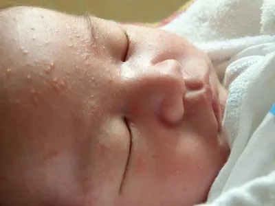 Гормональная сыпь у новорожденных: причины угревых неонатальных высыпаний у  ребенка, лечение