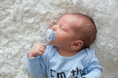 Высыпания на коже новорожденного: что маме об этом нужно знать - Parents.ru  | PARENTS