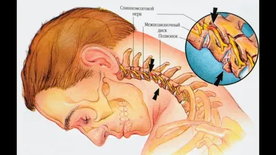 Грыжа в шейном отделе позвоночника фото