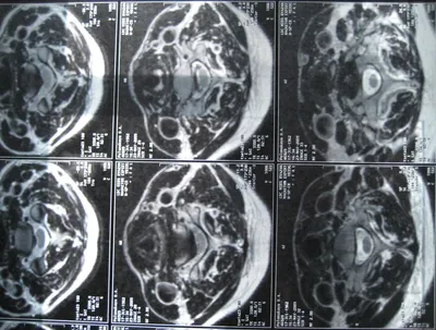 грыжа в шейном отделе позвоночника | Рентгенограммы | Сайт Тимура Гусейнова