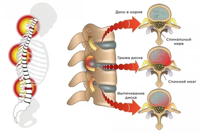 Причины возникновения грыжи позвоночника