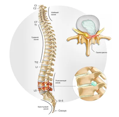 Лечение грыжи позвоночника поясничного отдела без операции | Симптомы и  методы диагностики межпозвонковых грыж | Клиника Ткачева Епифанова