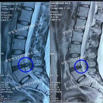 Результаты лечения межпозвонковых грыж и протрузий без операции, снимки МРТ  до и после, отзывы - Vertebra