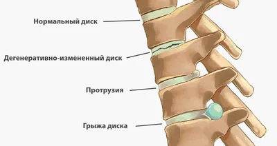 Протрузия и грыжа диска поясничного отдела позвоночника - Метод Козявкина