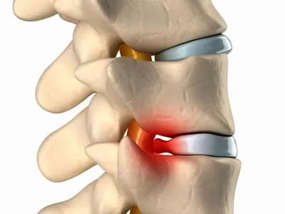 Грыжа Шморля ✔️: симптомы, признаки и причины, диагностика и лечение