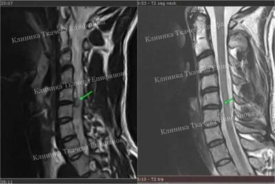 Грыжа шейного отдела позвоночника: симптомы и лечение | Клиника Ткачева  Епифанова