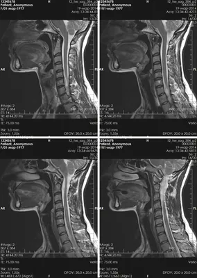 МРТ шейного отдела позвоночника - цена в Москве, сделать  магнитно-резонансную томографию