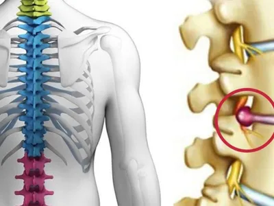 Грыжи межпозвонковых дисков - лечение в Херсоне | Neuro.ks.ua.