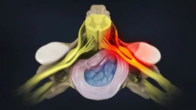Грыжа Межпозвоночного Диска Шейного Отдела