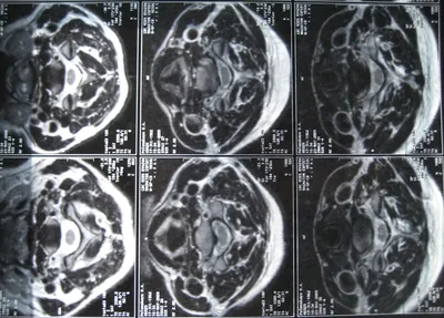 грыжа в шейном отделе позвоночника | Рентгенограммы | Сайт Тимура Гусейнова