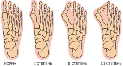 Лечение вальгусной деформации стопы в СПб: операции на косточке большого пальца  ноги