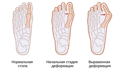 Как выбрать корректоры от «косточек» на больших пальцах?