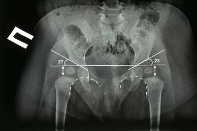 Дисплазия тазобедренного сустава рентген признаки | Второе мнение