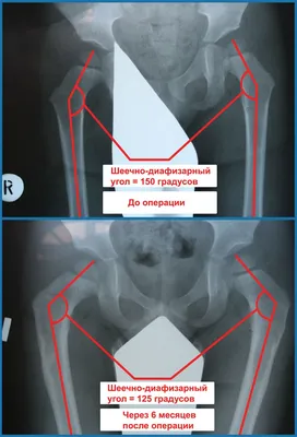 Дисплазия тазобедренных суставов | Bowlegs