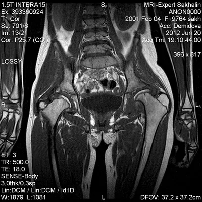 Дисплазия тазобедренных суставов-как это выглядит на МРТ | Портал радиологов