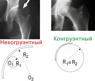 Файл:Congenital dislocation of the hip 7-1.jpg — Википедия