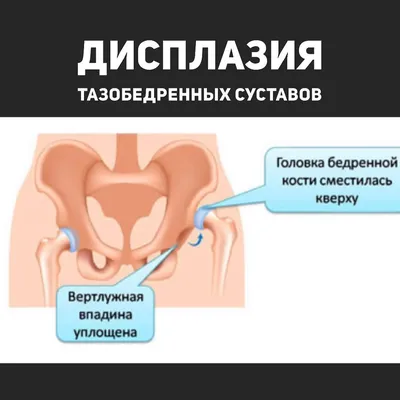 Дисплазия тазобедренных суставов у детей до года: признаки, лечение и  профилактика