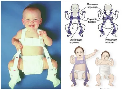 Дисплазия тазобедренных суставов: как действовать родителям грудничка -  Телеграф