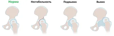 Дисплазия тазобедренных суставов | Остеопрактика