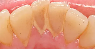 Зубной камень безболезненное удаление чистка ультразвуком в Севастополе |  Стоматология Жемчуг
