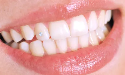 Красивые камни на зубах - особый шик