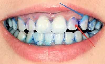 Почему образуется зубной камень