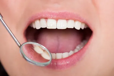 Причины возникновения зубного камня | Современная стоматология 32 зуба