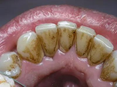 Зубные камни и налет: причины возникновения и лечение - Здоровые зубы