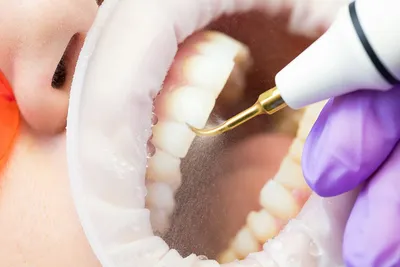 Можно ли беременным чистить зубной камень - Стоматологическая клиника VИТАЛЬ