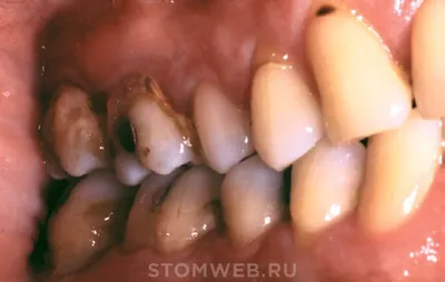 Роль зубного камня и других предполагаемых локальных факторов в заболевании  пародонта – STOMWEB.RU