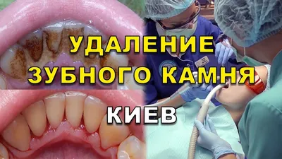 Чистка зубов (видео). Удаление зубного камня - Киев, Люми-Дент - YouTube