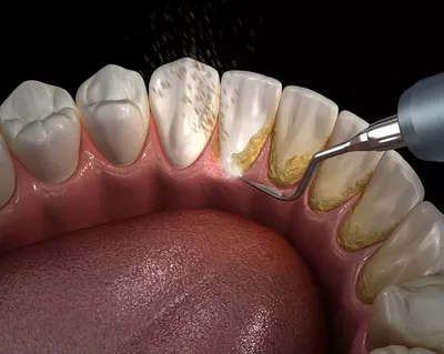 Что такое зубной камень. Как удаляют зубной камень