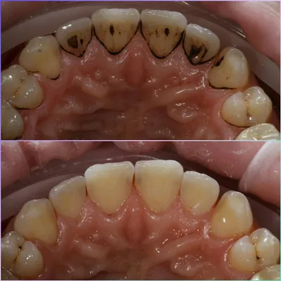 Профессиональная гигиена полости рта — это комплекс мероприятий,  обеспечивающих удаление зубного камня и налета на зубах. | SMAGA dental  clinic