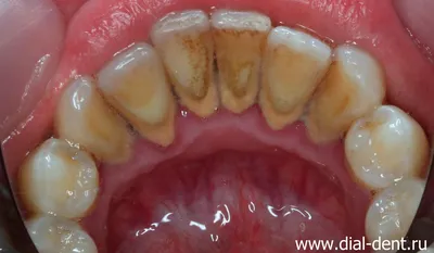 Снятие зубных отложений и лечение гингивита